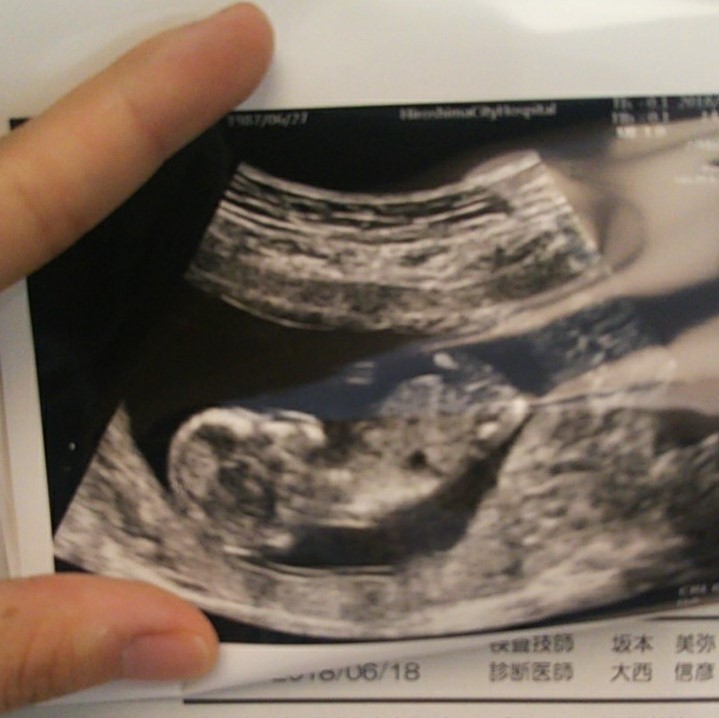 まさかの妊娠 双子ありで3人目をどう乗り越える 現在進行形 広島の育児情報 Pikabu ピカブ